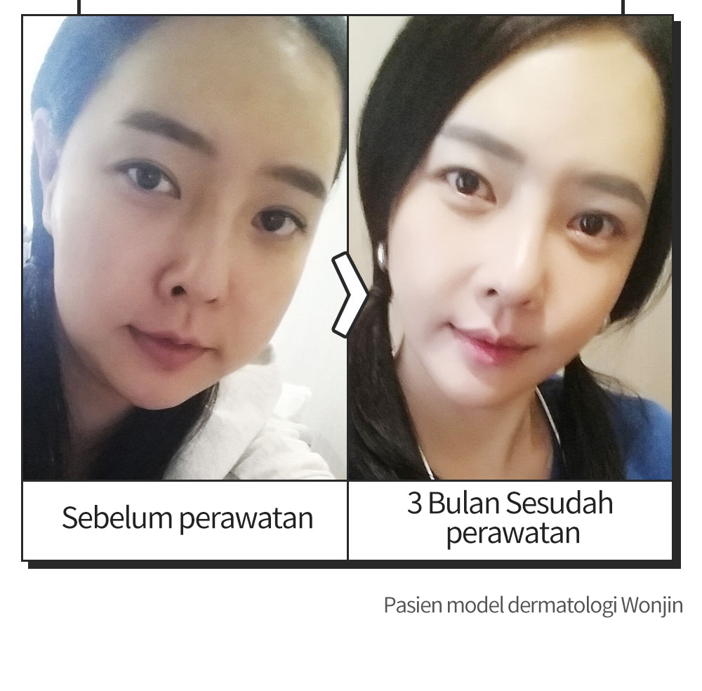Sebelum perawatan > 3 Bulan Sesudah perawatan , Pasien model dermatologi Wonjin