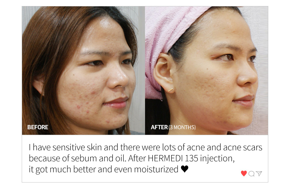 BEFORE & AFTER (3 MONTHS) , I have sensitive skin and there were lots of acne and acne scars because of sebum and oil. After HERMEDI 135 injection, it got much better and even moisturized ♥