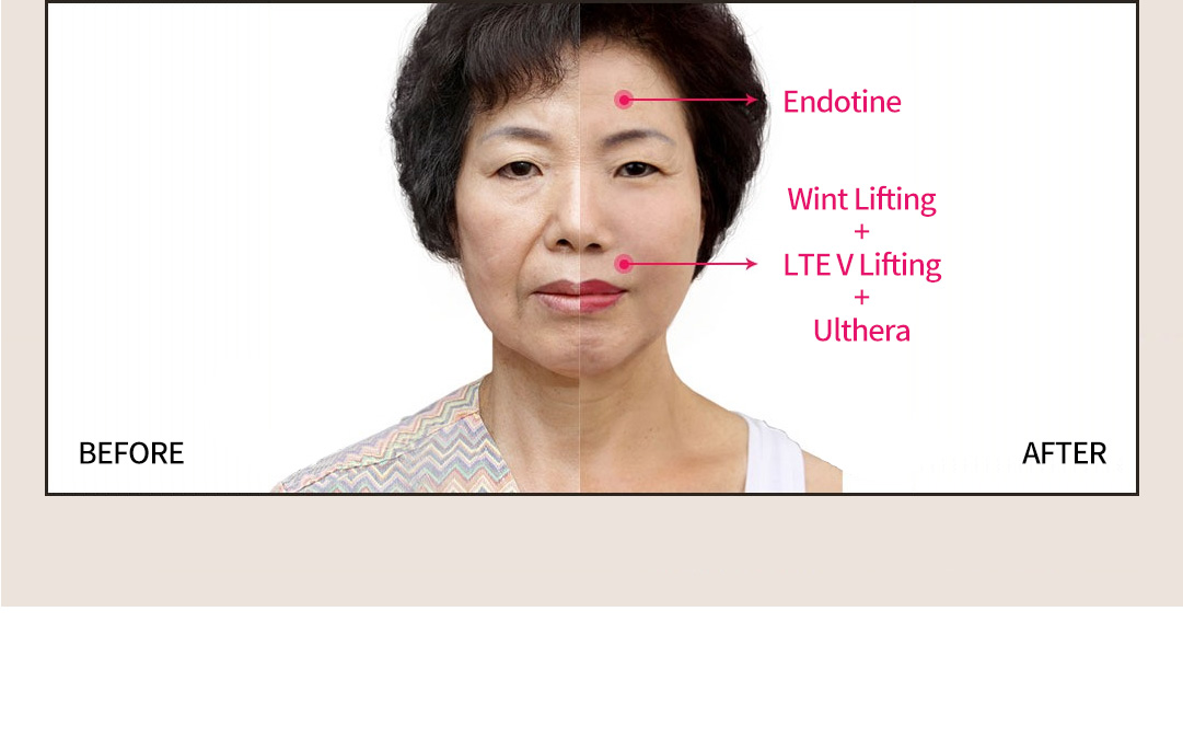 BEFORE / AFTER Endotine Wint Lifting +LTE V Lifting + Ulthera