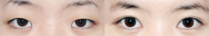 picanthoplasty & Non-Incisional Double Eyelid