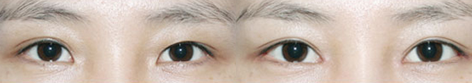 手术方法 : 开内眼角 &开外下眼角 &非切开式双眼皮术