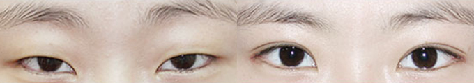 Lateral Canthoplasty & Non-Incisional Double Eyelid