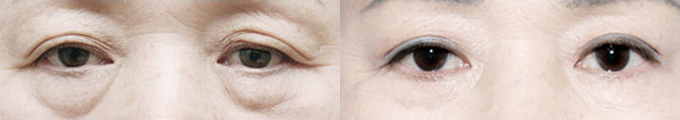 Upper Blepharoplasty & Lower Blepharoplasty & Under Eye Fat Graft
