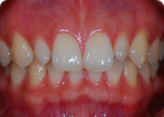 Премоляры и трещины зубов