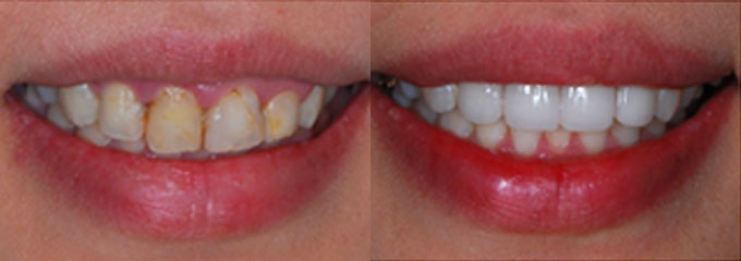 Изменение цвета зубов