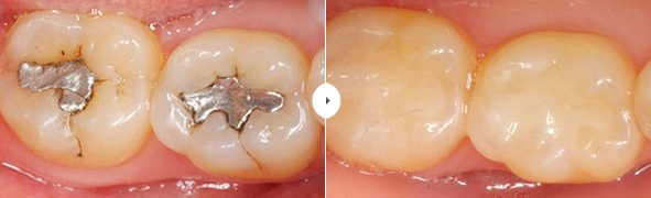 ประเภทของการรักษาฟันผุ การรักษาแบบฝัง (Inlay)