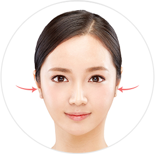 Side Cheekbone Reduction