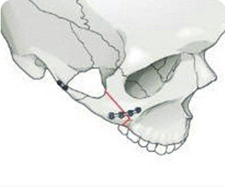 Surgical Methods of Cheekbone Reduction Step 03