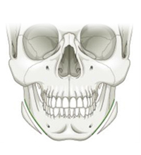 Резекция нижней челюсти