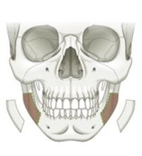 Резекция коркового слоя челюсти
