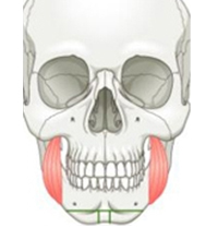 Т-образная остеотомия, сужающая переднюю часть челюсти