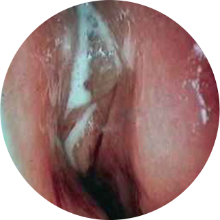 Воспаление носовой пазухи1