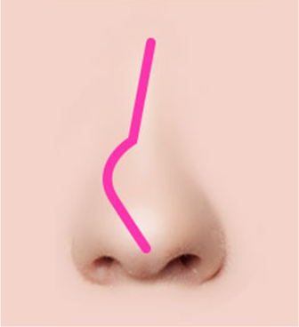 Various cases of deviated nasal septum