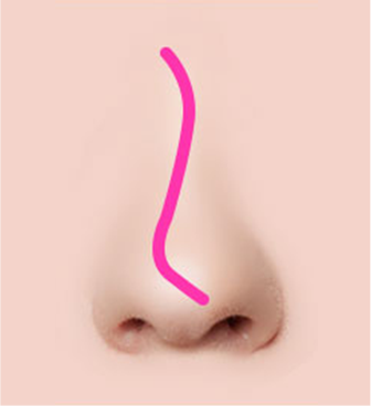 Различные виды искривления носовой перегородки
