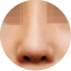 Bayangan implan terlihat dari kulit hidung karena batang hidung sempit / kulit tipis