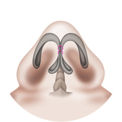 Spread-out nasal tip cartilage