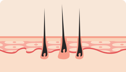 Transplantasi sel-sel folikel rambut ke dalam celah(pori-pori)