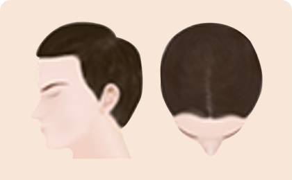 Процесс выпадения волос у мужчин 1