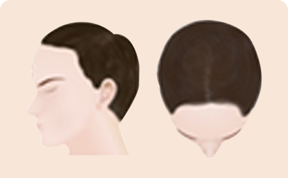 Процесс выпадения волос у мужчин 2