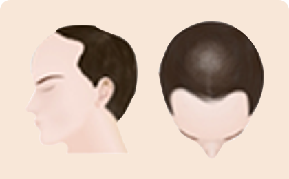 男士脱发的过程阶段3