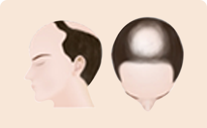 男士脱发的过程阶段4