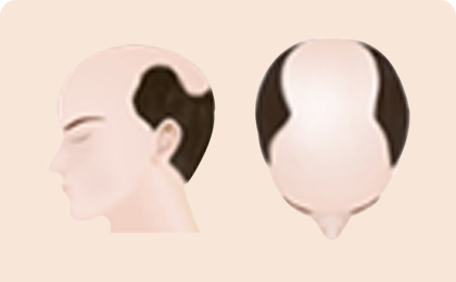 Процесс выпадения волос у мужчин 5