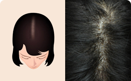 女性脱发的过程阶段1