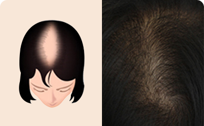 女性脱发的过程阶段2