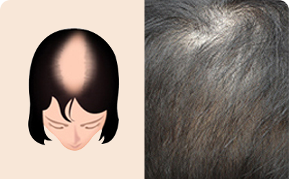 女性脱发的过程阶段3
