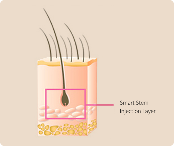 Smart stem injection layer
