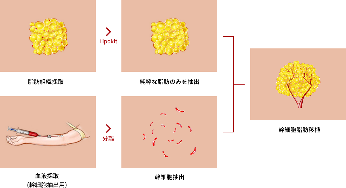 Process of W-ell Fat Grafting