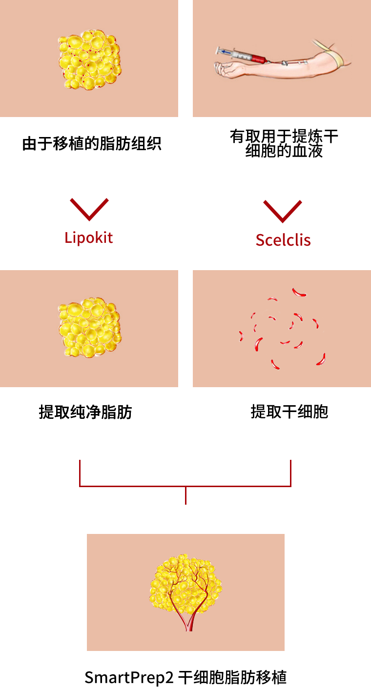 干细胞脂肪移植的过程
