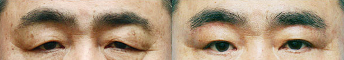 眉リフトアップ＆下眼瞼リフトアップ＆眼下脂肪手術