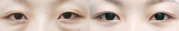 Коррекция мешков под глазами+верхняя блефаропластика (с разрезом)