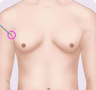 男性の乳房縮小の 手術方法01