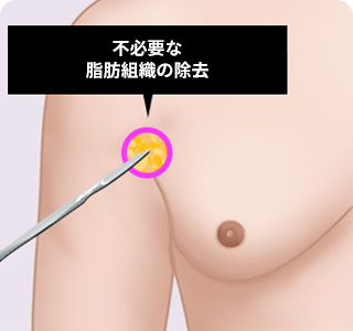男性の乳房縮小の 手術方法02