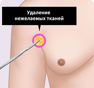 Хирургический метод уменьшения мужской груди2