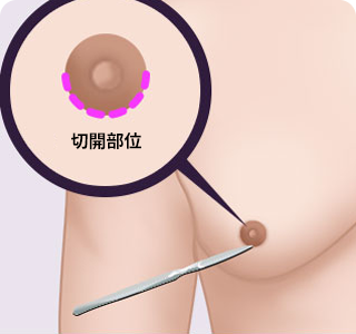 男性の乳房縮小の 手術方法03