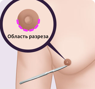 Хирургический метод уменьшения мужской груди3
