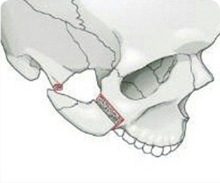 上顎と下顎の切骨