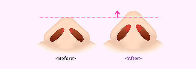鼻腔(鼻弁）再建手術のポイント01