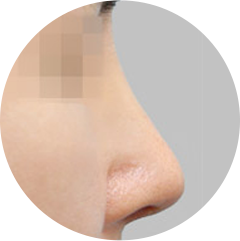 プロテーゼによる鼻先の変形