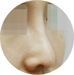 Опущение кончика носа