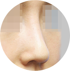Under-projected nasal tip